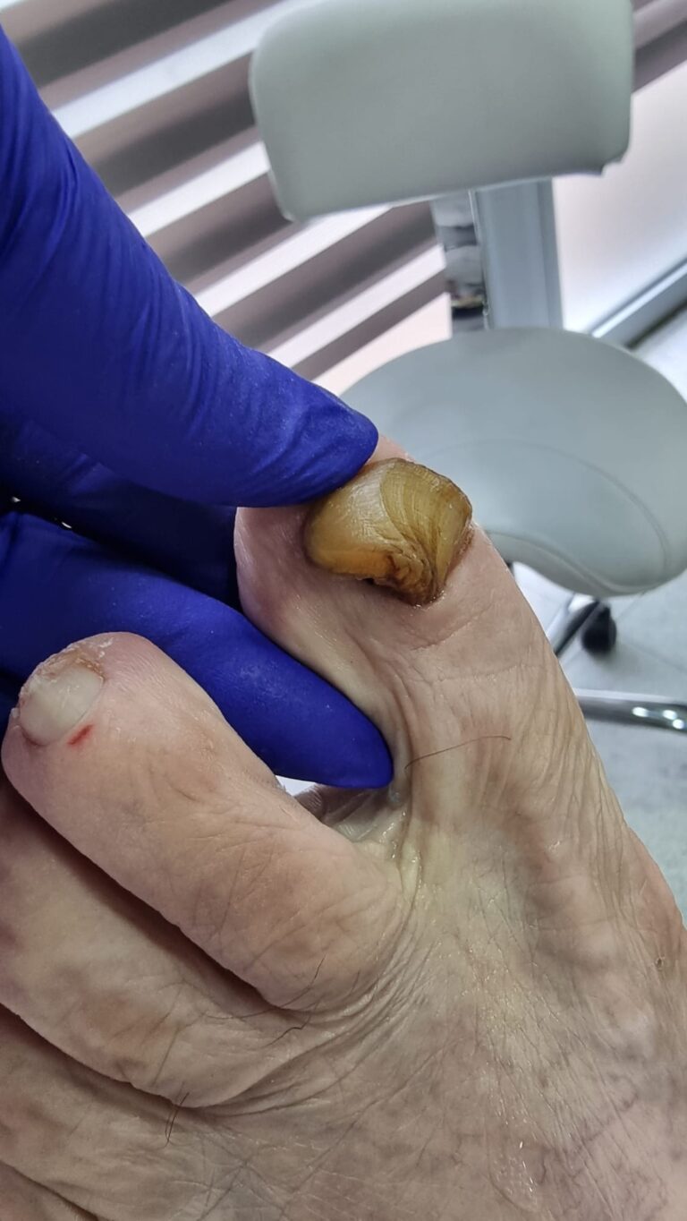 Zadebljanje i deformitet nokta palca — prije tretmana