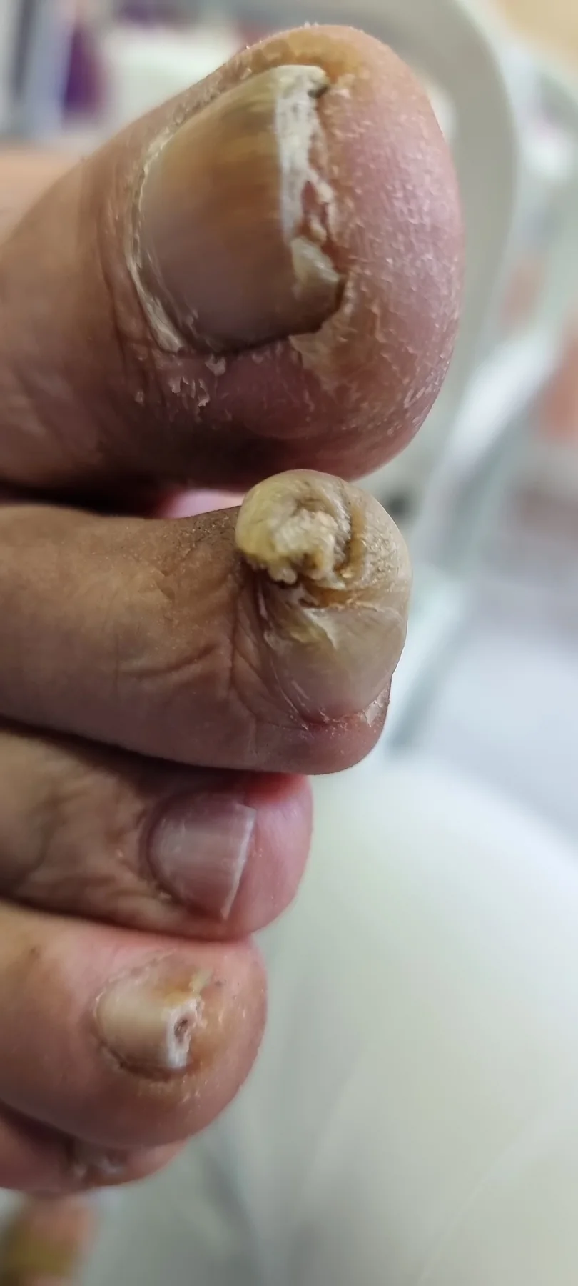 Zadebljanje i deformitet nokta palca — prije tretmana